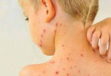 Crnoj Gori prijeti epidemija malih boginja